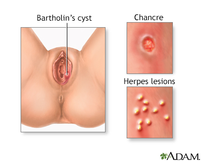 Sores or lesions on the female genitalia may have many causes. Sores or lesions on the female genitalia may have many causes.