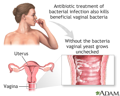 BacterialVaginosis Bacterial Vaginosis