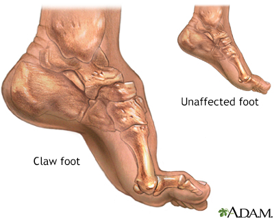 forefoot  pain foot