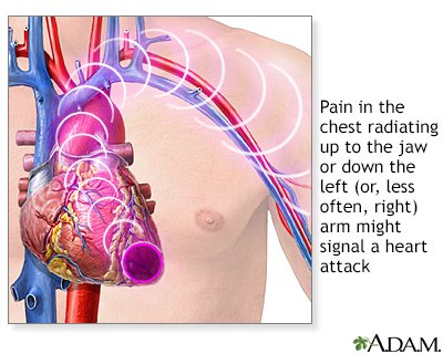 heart attack pain location. heart attack pain areas. heart attack pain location.